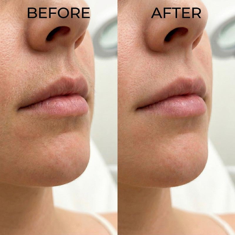 Inainte si Dupa Epilare 6